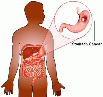 http://www.mobin-group.com/image/reg/images/7348-stomach-cancer.gif